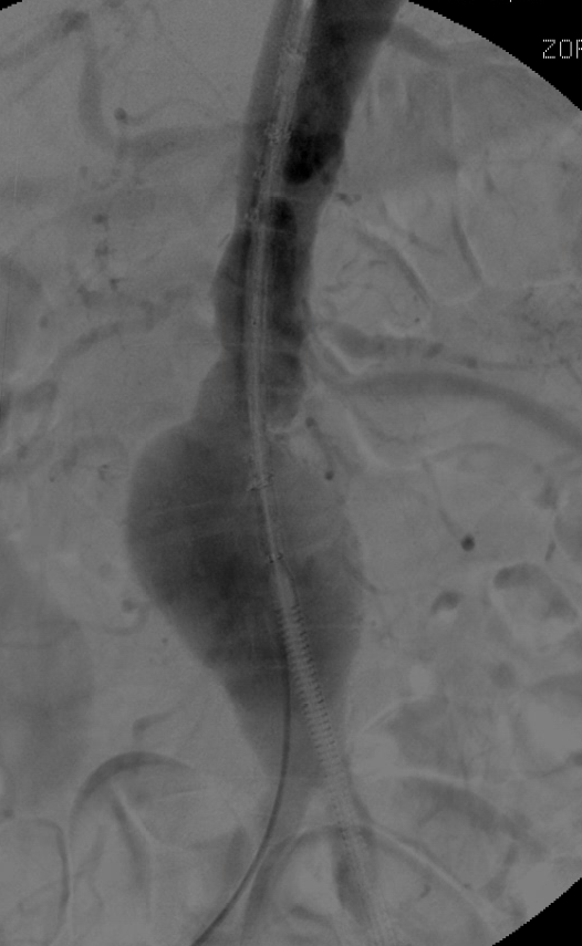 Intraoperative Angiografie während der Aortenaneurysma-Behandlung