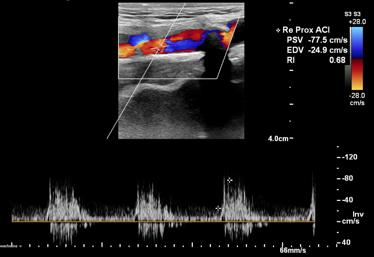 Farbduplex Sonografie - Proximal