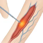 Moderne Radiofrequenzbehandlung von Krampfadern